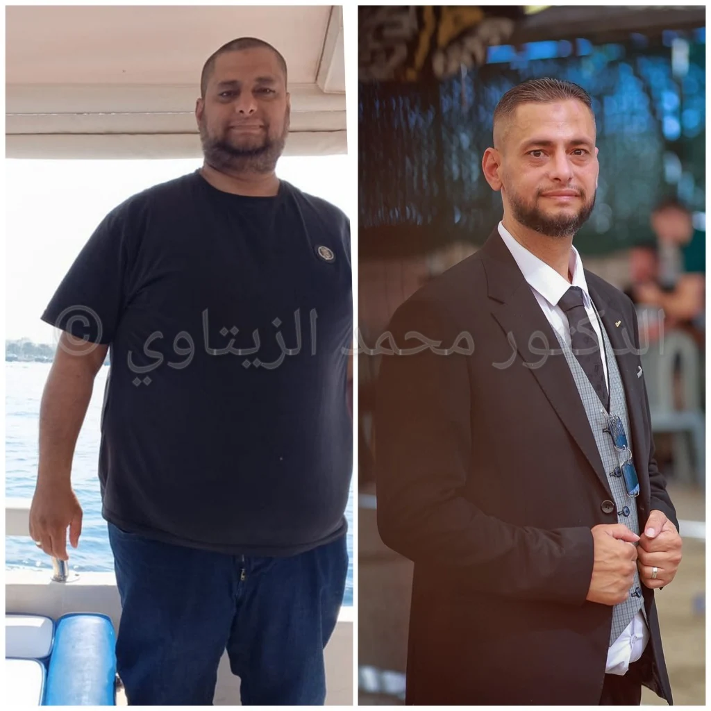 صورة قبل وبعد تحويل المسار المصغر لكنعان من فلسطين: من 140 كيلو إلى 81 كيلو، وما زال وزنه ثابتاً بعد 3 سنوات من العملية — مركز الدكتور محمد عبد الوهاب الزيتاوي
