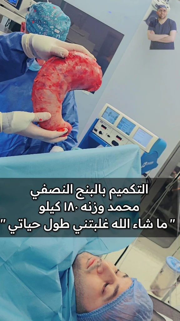 محمد بوزن 180 كيلو مستيقظ على طاولة العمليات بعد تكميم المعدة بالبنج النصفي، والفريق يحمل الجزء المستأصل من المعدة — مركز الدكتور محمد عبد الوهاب الزيتاوي